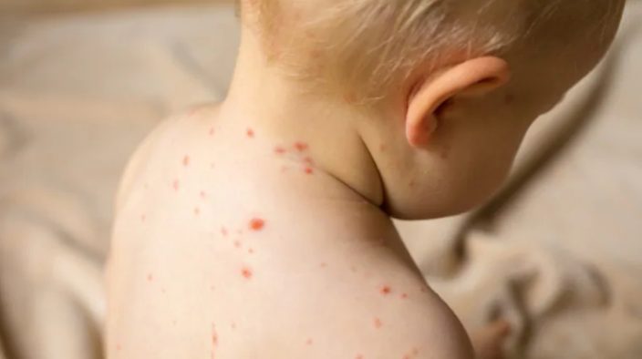 شیوع آبله‌مرغان در اتاوا