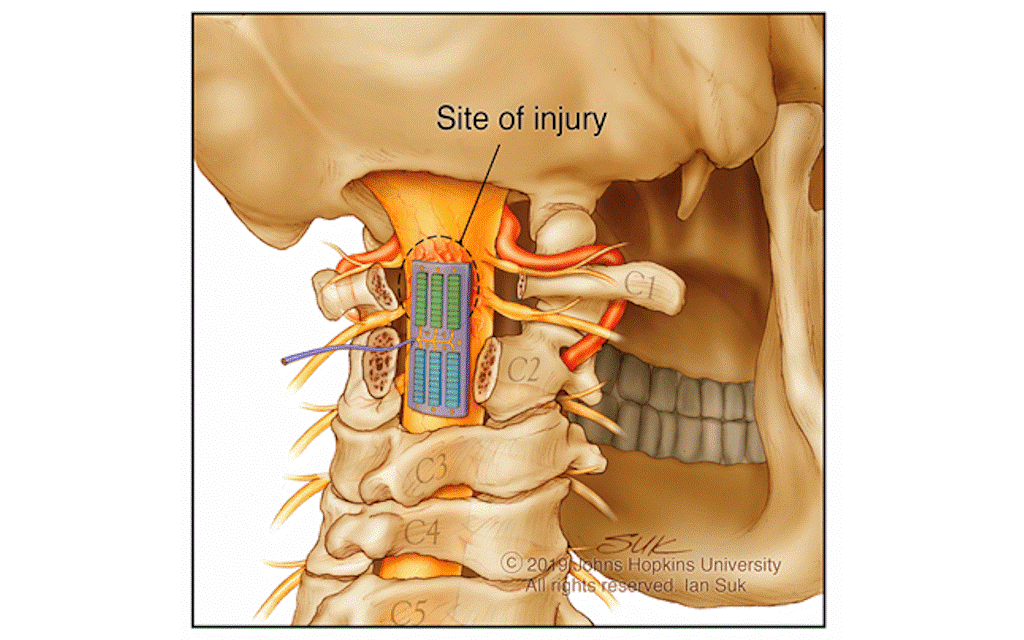 درمان آسيب‌های ستون‌فقرات